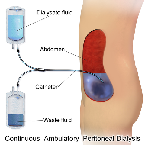 Diagram of peritoneal dialysis