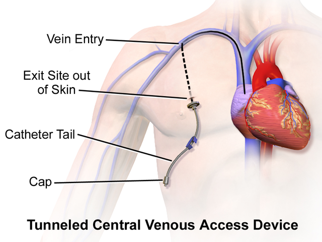 Pictured of tunnelled dialysis catheter