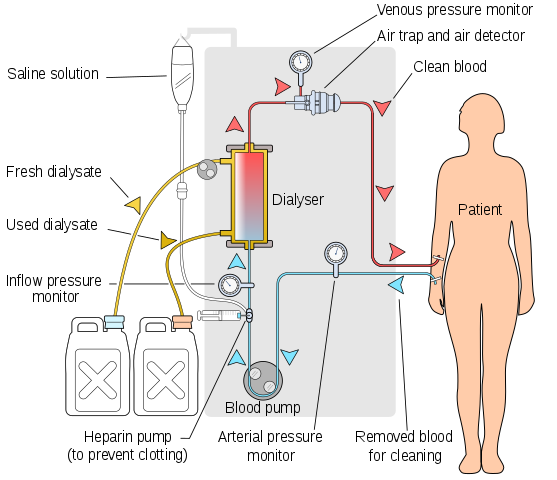 Diagram of haemodialysis