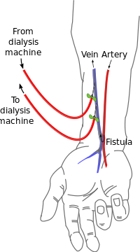 Radial fistula